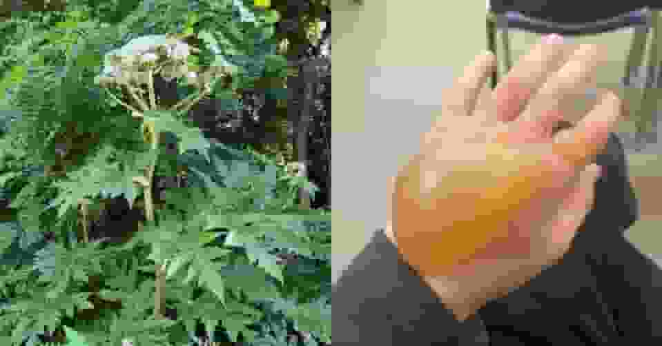 遊日注意 | 北海道大學疑驚現劇毒大豕草 專家發恐怖大水泡照示警