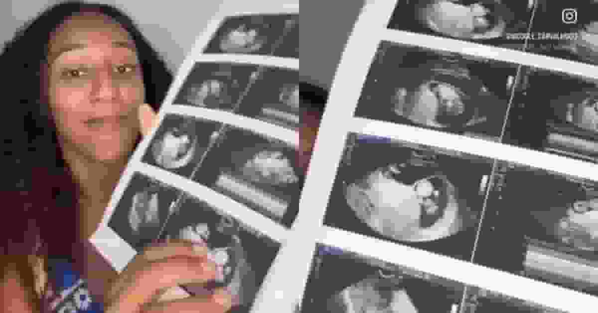 全球不足10例!巴西女孕期再受孕 同晚誕下差一周「異期孖胎」