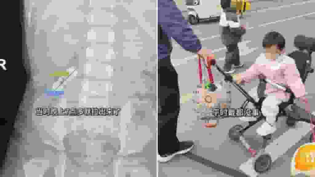 安徽1歲女吞3厘米髮夾翻白眼 靠食韭菜成功屙出